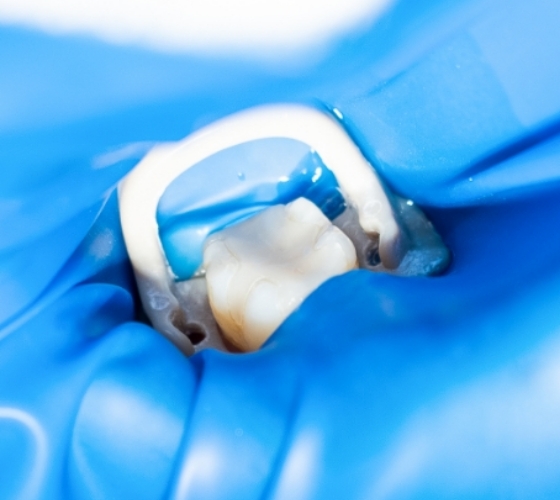 ラバーダム防湿下で根管治療中